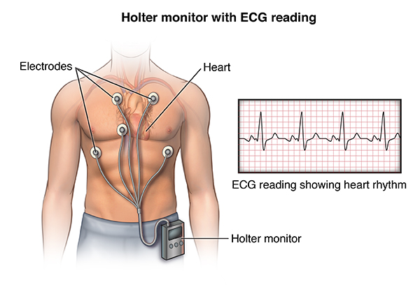 EKG Holter